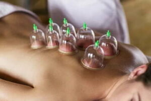 cupping 1