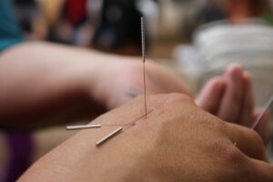 acupuncture, needles, hand-6324472.jpg