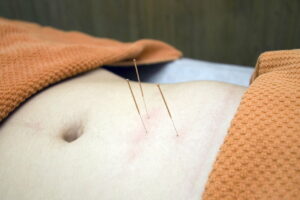 acupuncture, physiotherapy, wellness-4175624.jpg