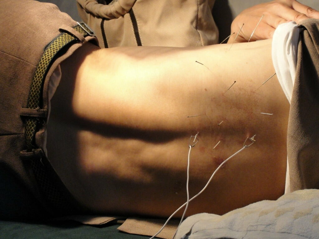 how much does acupuncture cost