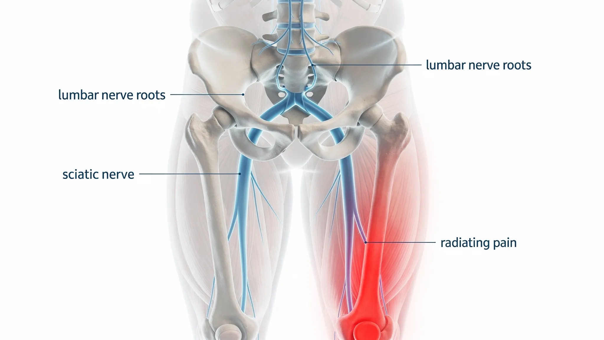 A clear anatomy-style illustration of the lower spine, pelvis, and sciatic nerve pathway highlighted from the lumbar area through the buttock down the back of the leg, with simple labels for “lumbar nerve roots,” “sciatic nerve,” and “radiating pain.”